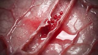 Extreme blood pressure spikes can damage delicate blood vessels in the brain