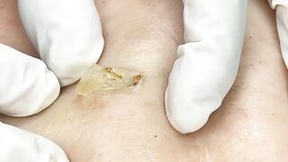 [ASMR] Sharp Ingrown Trimmed! Professional Pedicure DR LEE’S ULTIMATE ZITPOPPER 20052025M2 2593