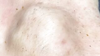 [ASMR] Sharp Ingrown Trimmed! Professional Pedicure DR LEE’S ULTIMATE ZITPOPPER 20052025M2 2584