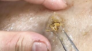 [ASMR] Sharp Ingrown Trimmed! Professional Pedicure DR LEE’S ULTIMATE ZITPOPPER 12062025m3 1882