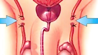 Why Are More Men In Their 20s Having Vasectomies?