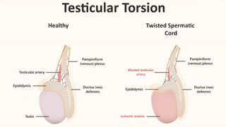 Testicular Torsion symptoms, causes, diagnosis & treatment