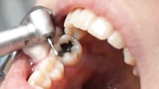 Black cavity cleaning short video