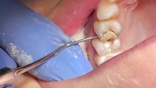 Dentist TarTar