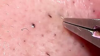 Cravo de cabelo