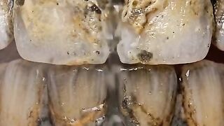 Wait Until You See This Tooth Extraction! | 看到最后！这个拔牙过程太意外了 | 끝까지 보세요! 놀라운 발치 과정