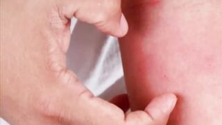 Anaphylaxis short overview