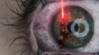 Unknown facts about Doctor's Eye Laser Surgery #Shorts