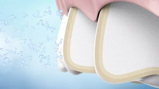 Professional teeth whitening system