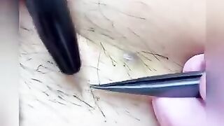 ЭлектроЭпиляция(360p).