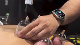 Hijama