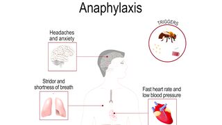 Anaphylaxis symptoms, causes, diagnosis & treatment