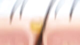 😱 Why Do Pimples Appear? Causes You Might Not Know!