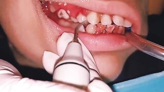 Dental calculus ||Gingivitis and calculus deposition|| Dental plaque|| surgical