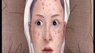 Acne treatment of girl face.