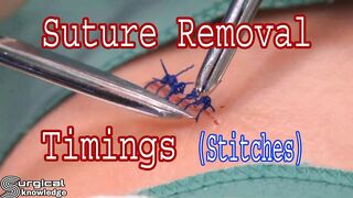 Difference types of stiches removal time