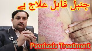 Psoriasis treatment|how to treat Psoriasis patient