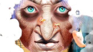 ASMR Gaint Acne and Black Head Pimple Removal- Acne Deep Cleaning Animation