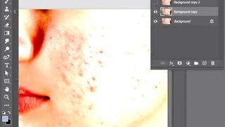 how can remove pimple in photoshop