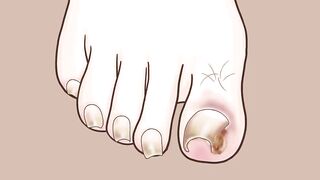 ASMR Coolness! Ingrown Toenail removal treatment animation