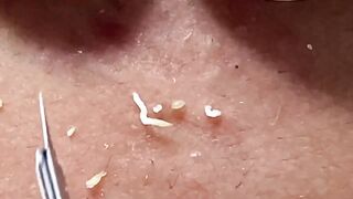 Blackheads Whiteheads removal Skin whitening