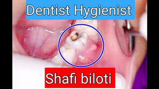 Tooth abscess ????