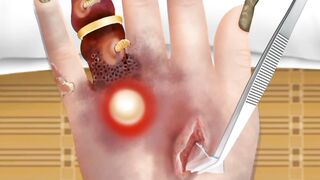 Asmr Animation treatment Hand indicated Treatment