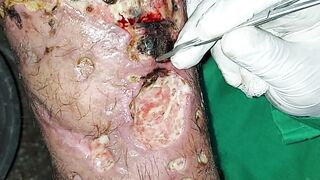 Injectable patient wash of wound