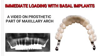 Immediate Implant / Basal Implant with in 72 Hours