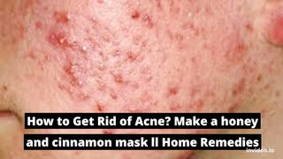 How to Get Rid of Acne? Make a honey and cinnamon mask ll Home Remedies