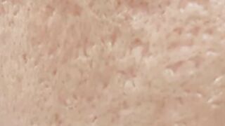 About Acne