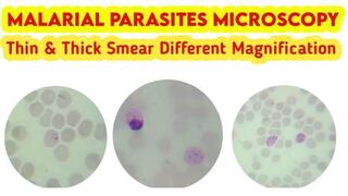 Malarial Parasites Under Microscope Plasmodium Vivax