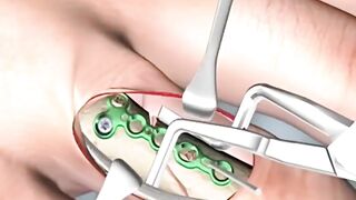 Finger fracture surgery