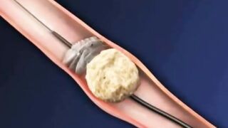 The removel Kidney stones.