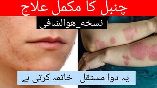 chambal ka ilaj I chambal ka ilaj urdu I chambal ka nuskha