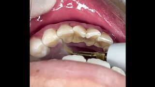 teeth scaling by dr adnan