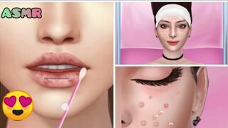 ASMR pimple removal