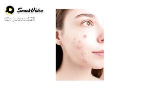 Acne treatment