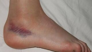 Causes of Ankle Sprain | Ligament tear | Febstop.com