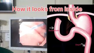 Billroth II procedure