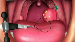 {ASMR} Tonsils Remove with Surgery