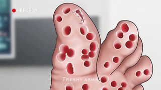 ASMR Pedicure contagious viral warts all over the feet | Foot care animation