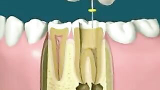 How a rout canal works