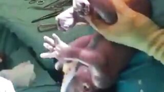 C-Section Baby Birth || Safe delivery C-section || Push Naturally || Natural birth || Home birth