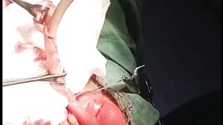Worm in appendix, Appendectomy