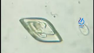 Uric acid crystals under microscope