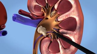 {ASMR} Kidney Stone Remove With Surgery
