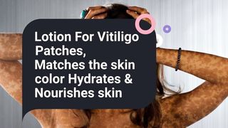 MELGA BRONZE Lotion For Vitiligo