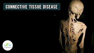 Stoneman Syndrome | Rare disorder | Fibrodysplasia ossificans progressive | Febstop.com | I am Physiotherapist