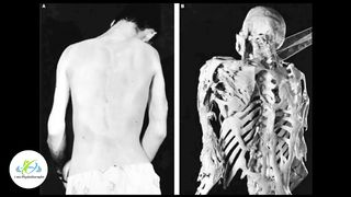 Stoneman Syndrome | Rare connective tissue disease | FOP | Febstop.com | I am Physiotherapist